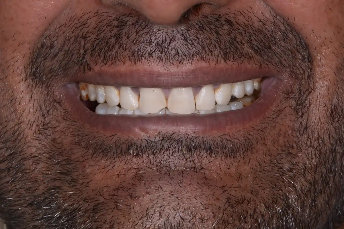 Après blanchiment laser Tunisie – dents blanchies résultat VIP Smile